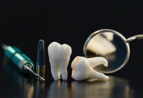 Trồng răng giả hoàn hảo như răng thật bằng Implant