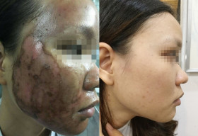 ‘Cô gái da rắn’: Cảnh tỉnh cho những phụ nữ mê làm đẹp cấp tốc giả rẻ